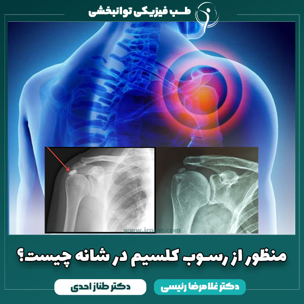 علت رسوب کلسیم در شانه + تشخیص و درمان تاندونیت کلیسیفیک
