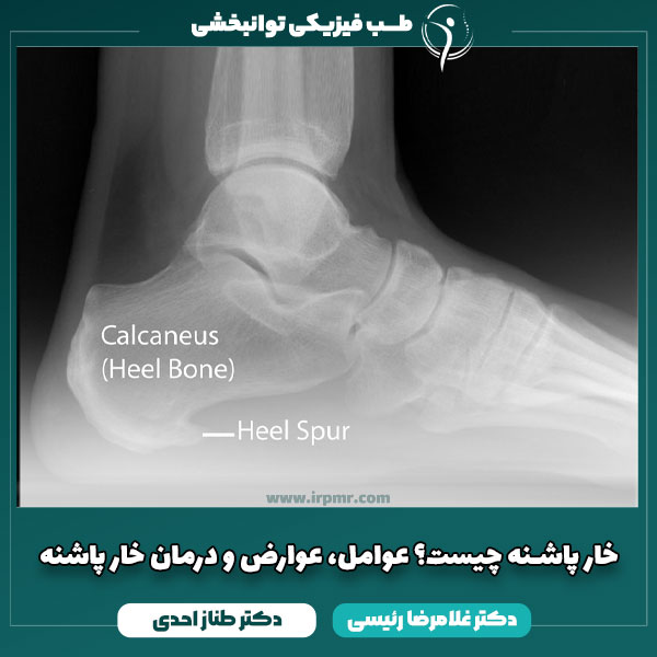 خار پاشنه چیست؟ عوامل، عوارض و درمان خار پاشنه